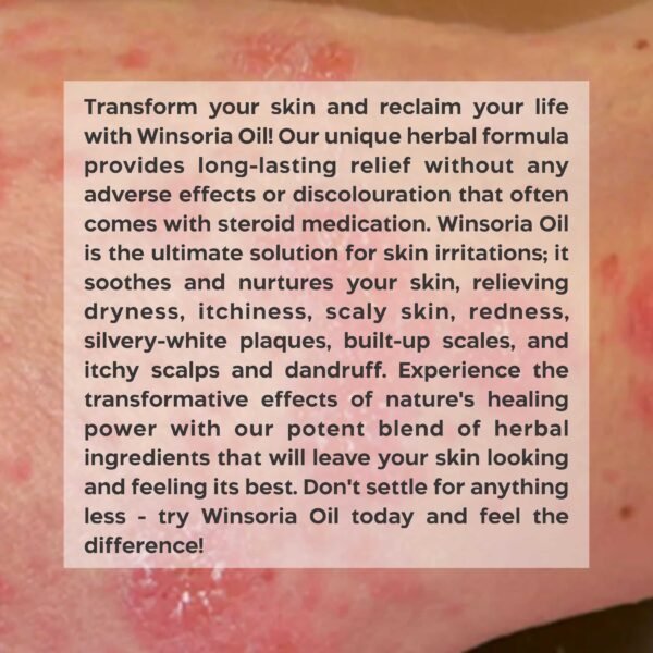 Srishma Winsoria Oils | minimizes itching, discoloration of skin |2×100 ml | - Image 4